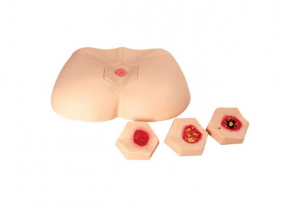 The characteristics of the phased pressure ulcer care model